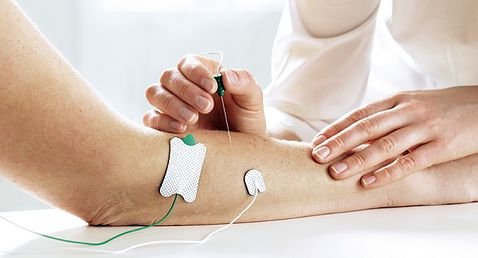 Eletroneuromiografia - agulha e eletrodos ligados ao braço durante o exame